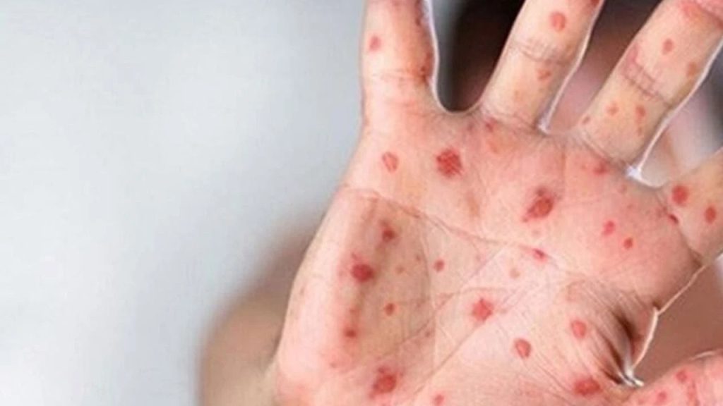 Gana’da M çiçeği vaka sayısı 197’ye yükseldi