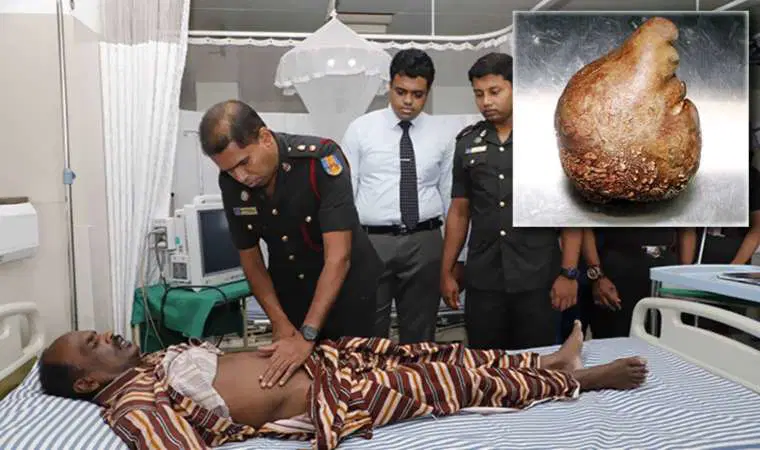 Sri Lanka’da bir hastadan 3,1 kilogram ağırlığında mesane taşı çıkarıldı